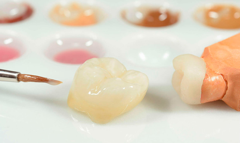 Artificial crown on a tooth